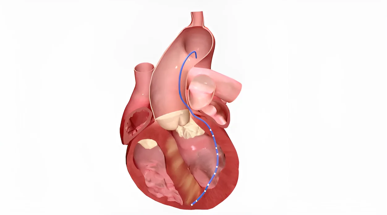 Alkol Septal Ablasyon
