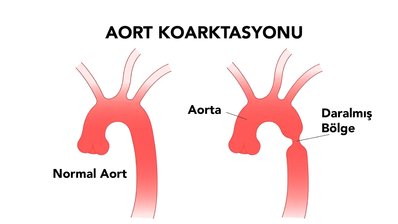 Aort Koarktasyonu