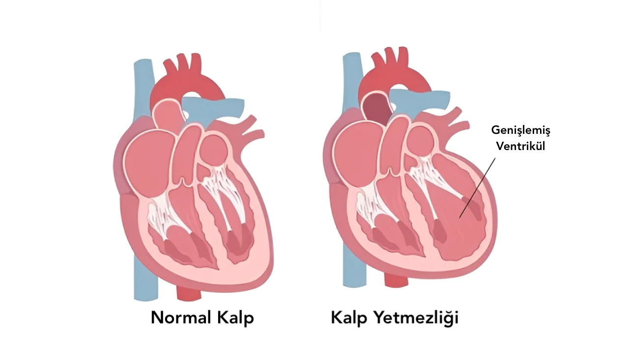 Kalp Yetmezliği