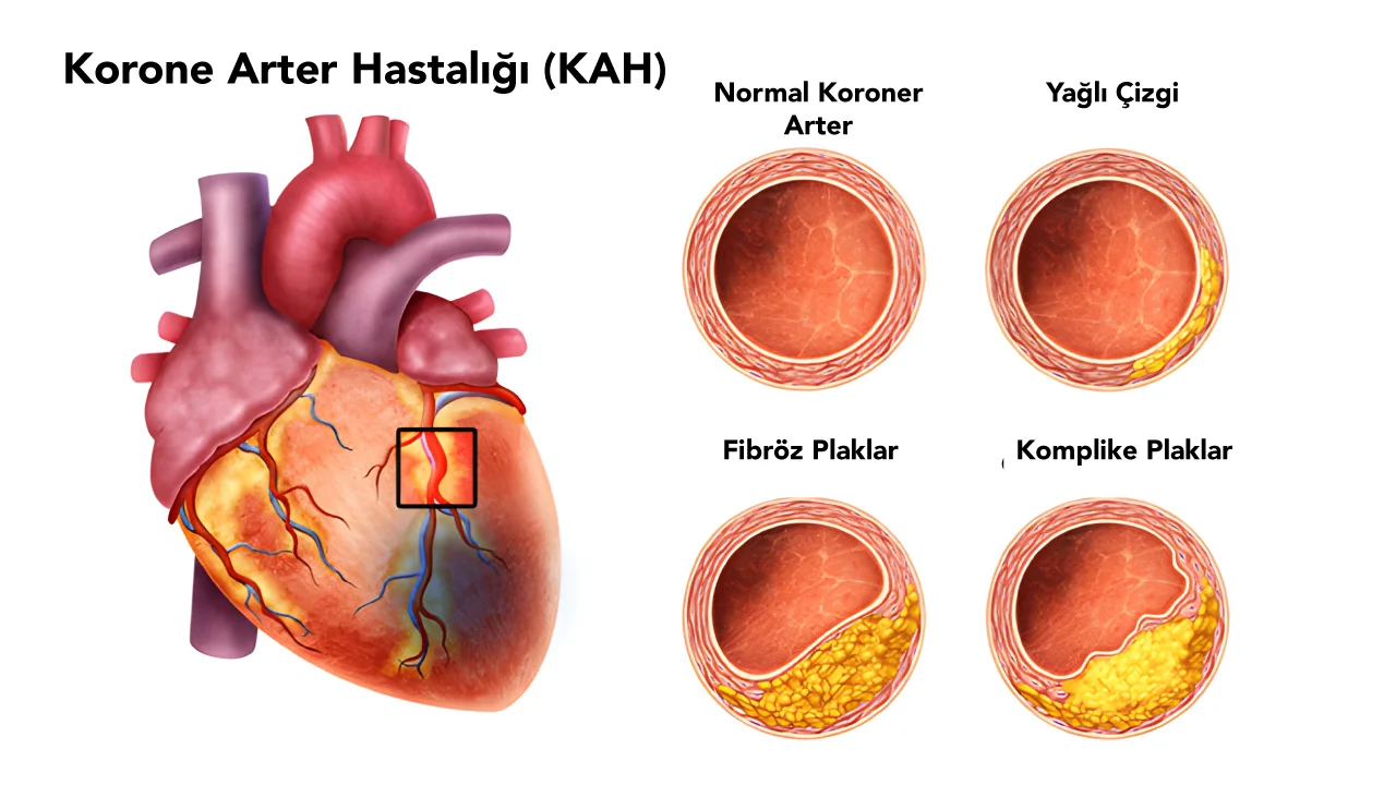 Koroner Arter Hastalığı