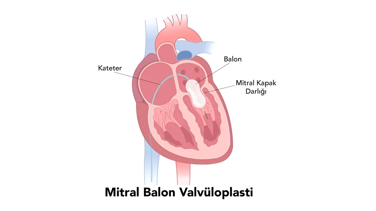 Mitral Balon Valvüloplasti
