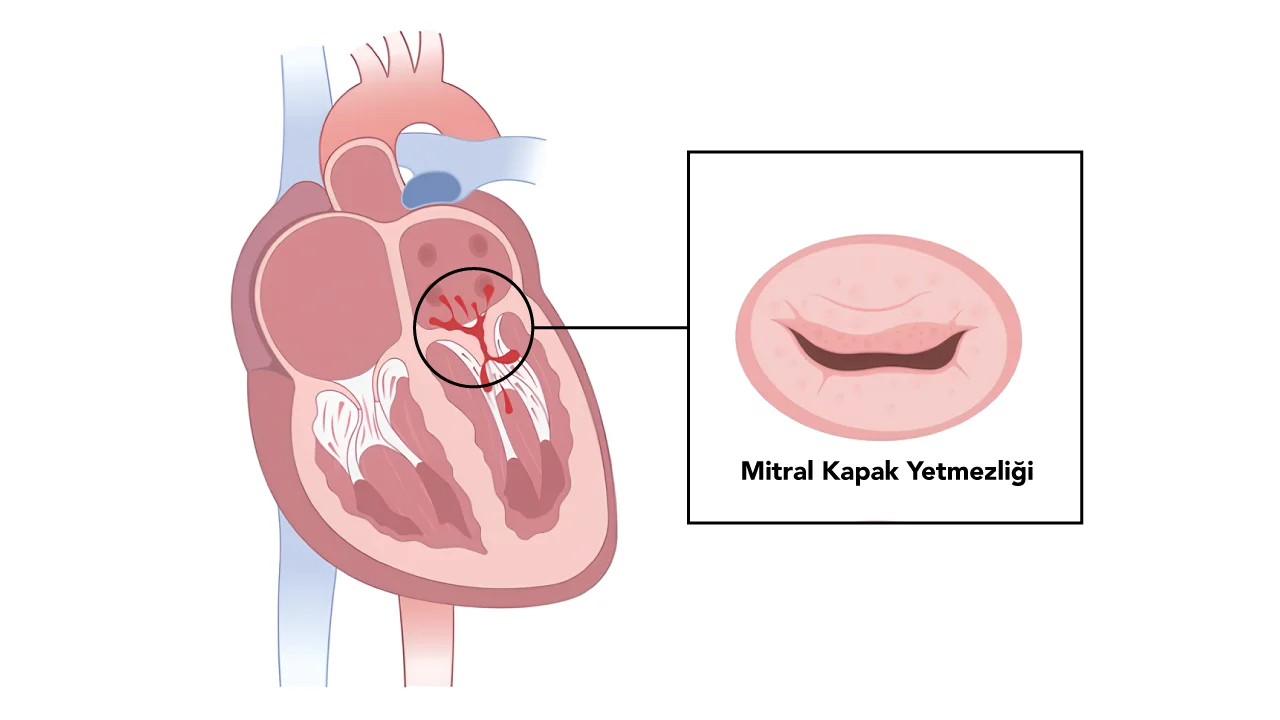 Mitral Kapak Yetmezliği