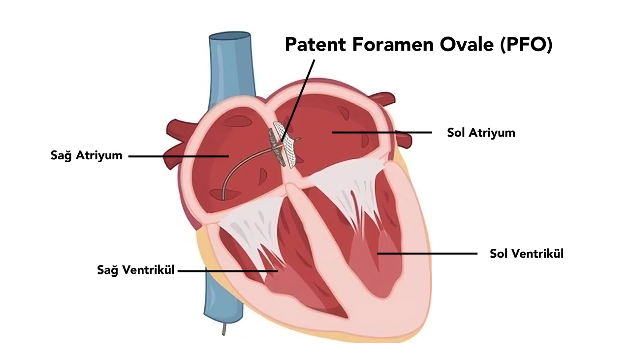 Patent Foramen Ovale (PFO)