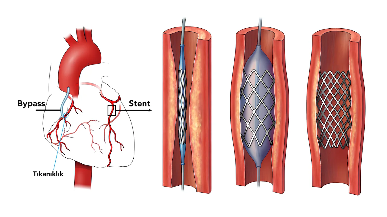Stent mi? Bypass mı?
