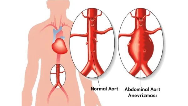 Aort anevrizmasi