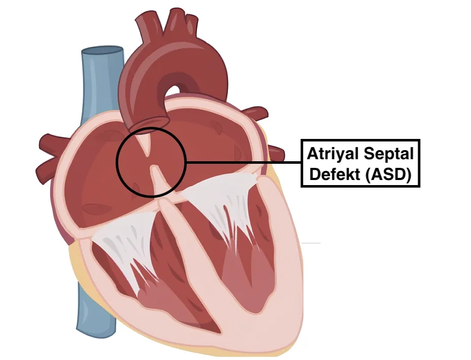 Atriyal Septal Defekt (ASD)